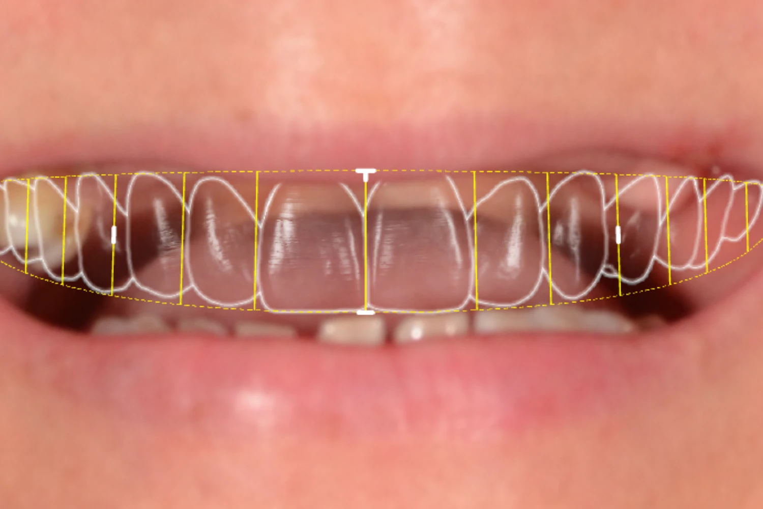Os dentes antes do tratamento, com o desenho digital do sorriso sobreposto