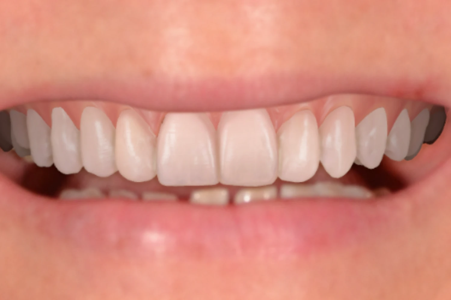 O sorriso depois do tratamento, com as peças cerâmicas instaladas