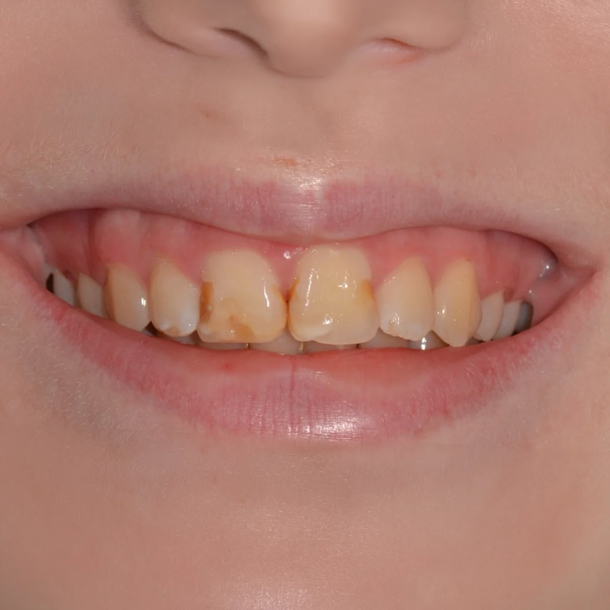 Sorriso antes do tratamento, com os dentes da frente escurecidos e desgastados