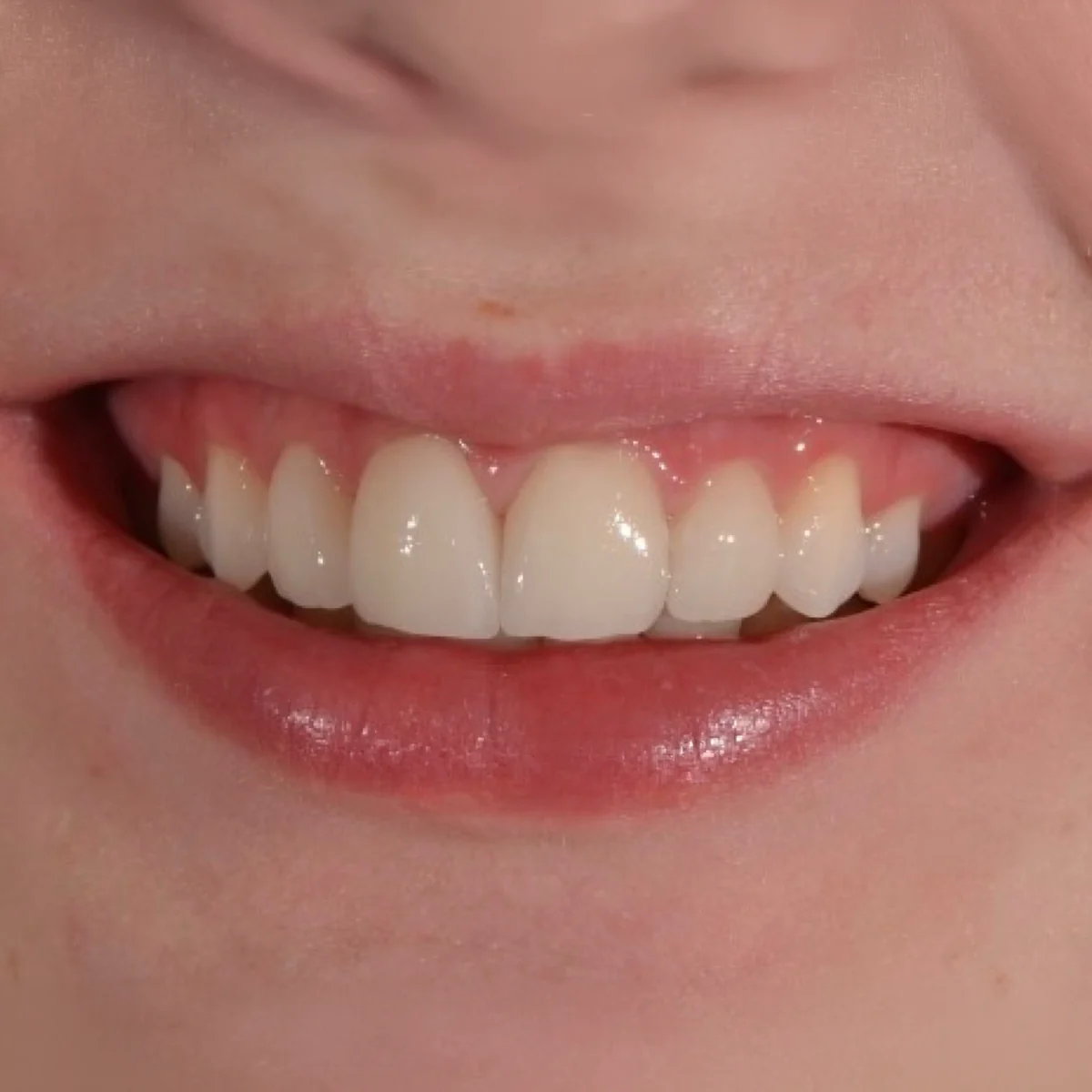 O mesmo sorriso depois das facetas cerâmicas, com cor e formato corrigidos