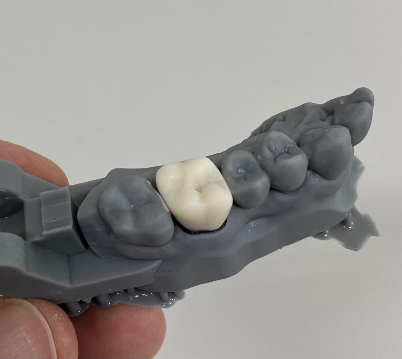 Modelo impresso em 3D no laboratório da clínica, com a coroa cerâmica posicionada sobre o implante