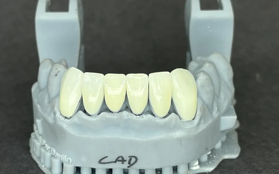 Modelo impresso em 3D no laboratório da clínica, com a prótese cerâmica posicionada e a marcação CAD do planejamento digital